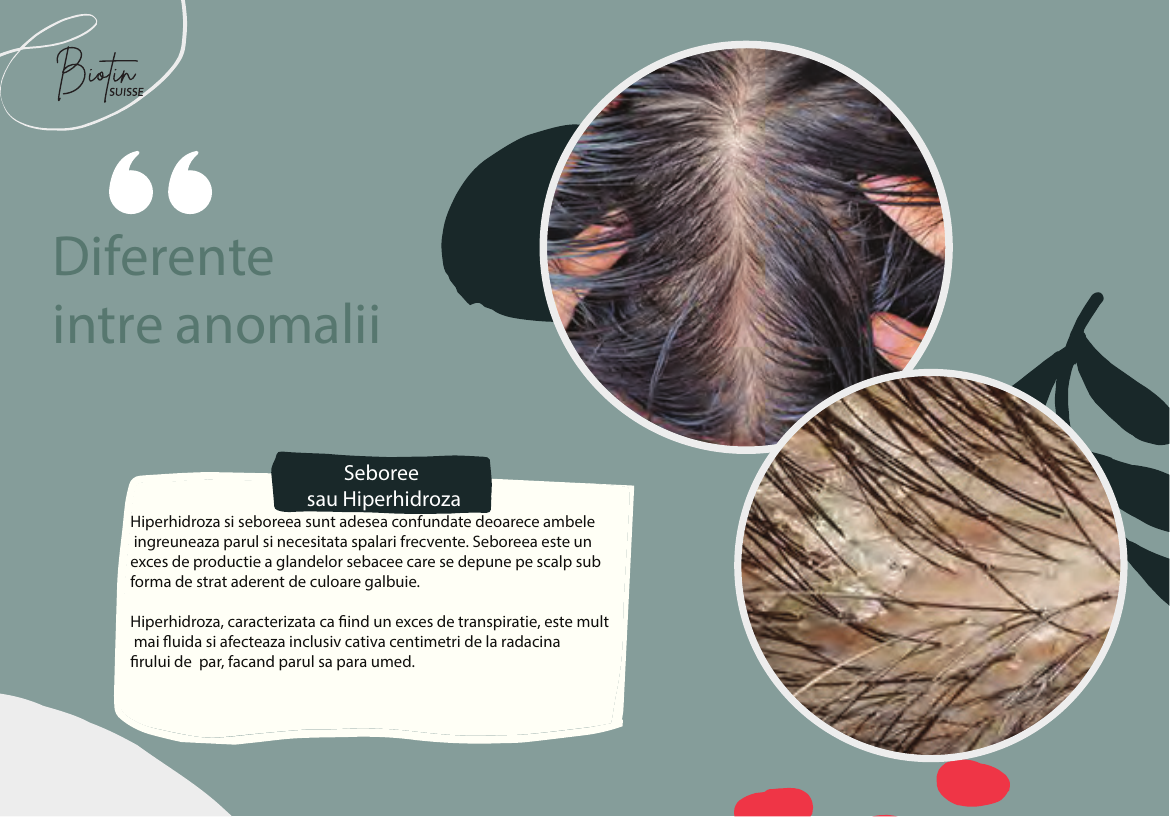 Diferențe între anomalii — Seboree sau Hiperhidroză
